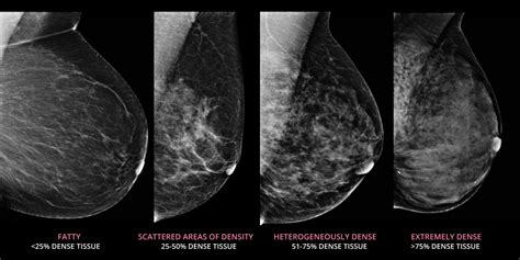 breast wikipedia|Category:Breast .